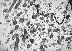 F,39y. | metastatic alveolar sarcoma of soft parts